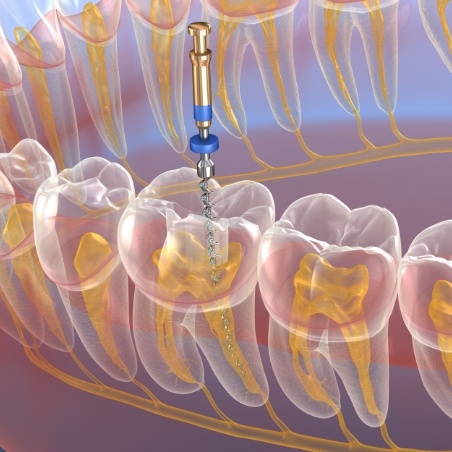 Illustrated dental instrument treating the inside of a tooth