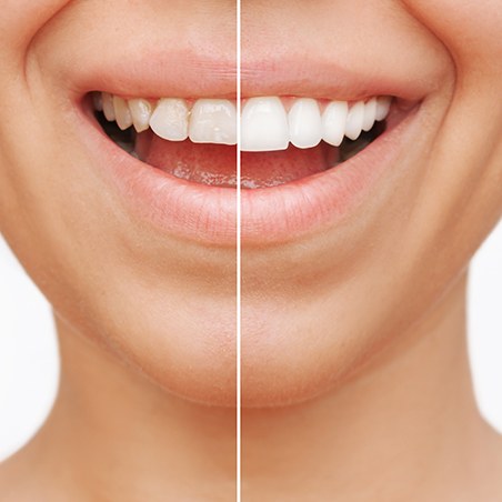 Patient's smile before and after veneers